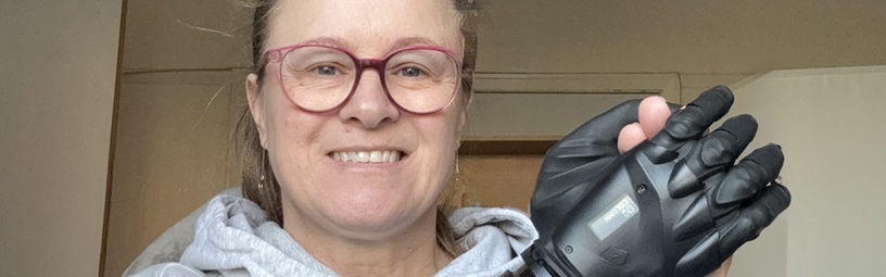 Wirral Limb Centre’s First Multi-Grip Hand Patient: Julie Griffin’s Life-Changing Journey Wirral Limb Centre’s First Multi-Grip Hand Patient: Julie Griffin’s Life-Changing Journey