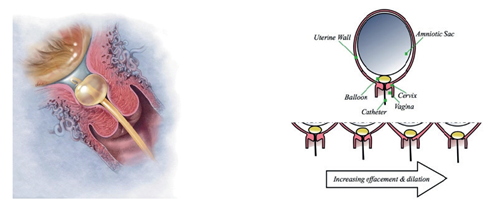 Photo of cervical ripening balloon resting on the top of the cervix. Diagram of the cervical ripening balloon in the cervix.