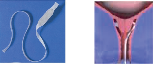 Photo of Propess Pessary and a photo of the Propess Pessary inserted into the posterior fornex of the cervix (behind it).